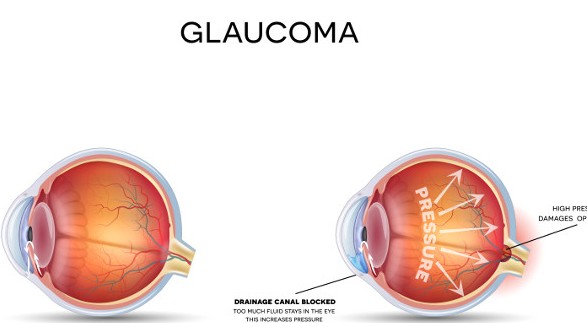 Glaucoma: “ladro silenzioso della vista”. In Sicilia impianti con una metodica innovativa