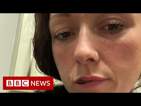 Botox injections and lip fillers banned for under-18s in England – BBC News