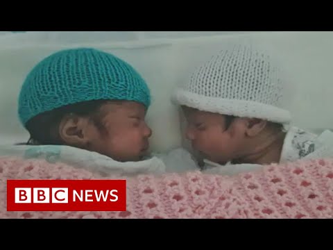 Woman in Covid coma gives birth to twins – BBC News