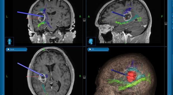 Caltanissetta, intervento neurochirurgico con l’aiuto della trattografia