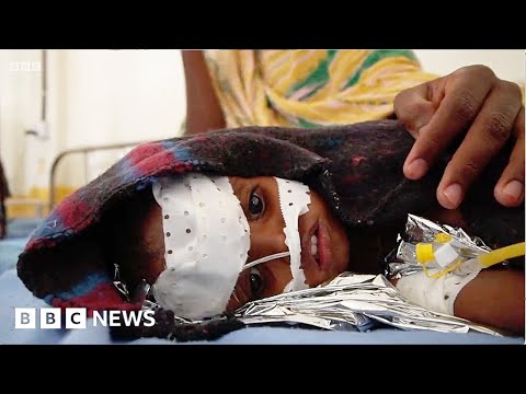 Children losing fight for life in Somalia as catastrophic famine looms  – BBC News