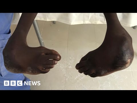 How clubfoot treatment is transforming Senegalese children’s lives – BBC News