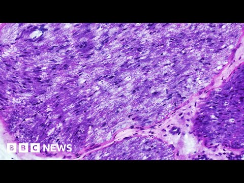 Can recurring breast cancer be spotted with AI tech? – BBC News