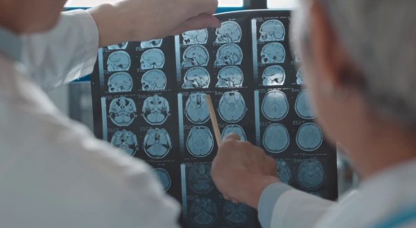 Alzheimer, terapie allo studio per rallentare il decorso