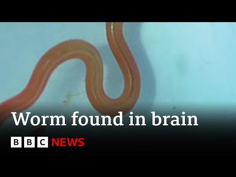 Live worm found in Australian woman’s brain – BBC News