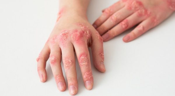 Salutequità e Apiafco “La psoriasi entri nel Piano Nazionale Cronicità”