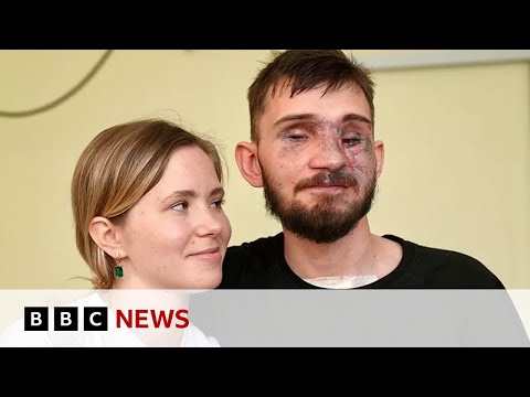 How Ukraine’s war wounded repair their lives – BBC News